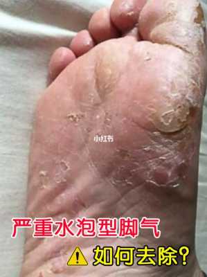 慢性湿疹泡脚有用吗（慢性湿疹可以每天温水清洗吗）