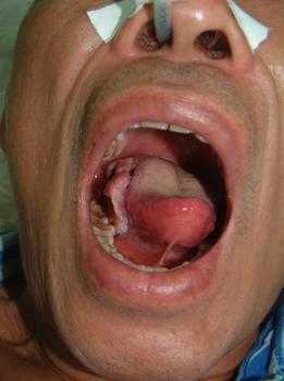 舌癌晚期切除有用吗（舌癌晚期术后复发几率）